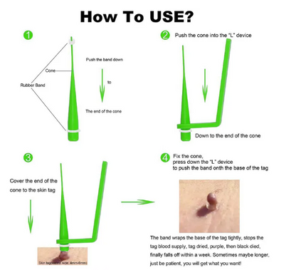 Auto Skin Tag Removal Kit